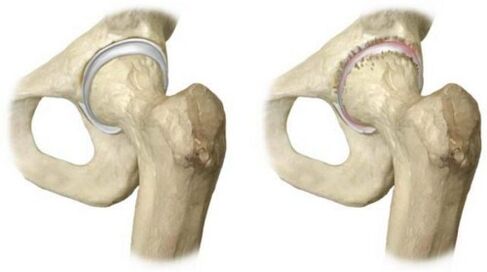 egészséges és arthrosisban érintett csípőízület